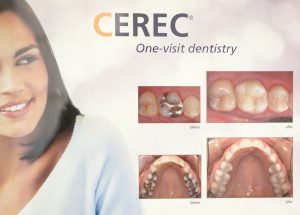 CEREC